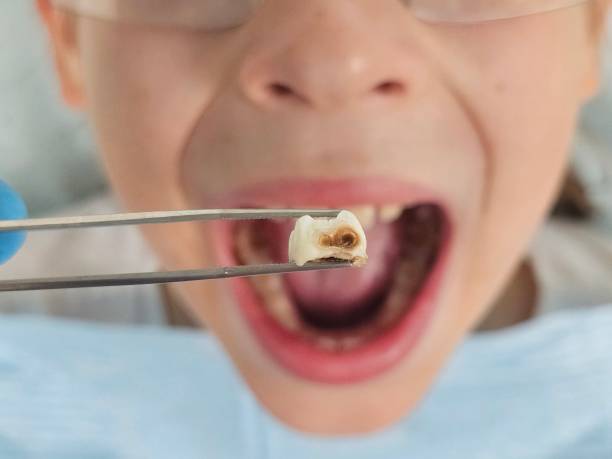 Best Emergency Dentist for Lost Fillings or Crowns in Nixon, TX